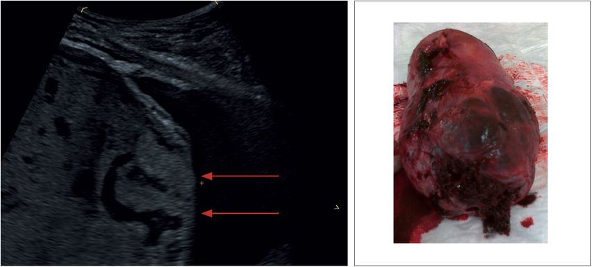 Abnorm invasive Plazenta erkennen - Gynäkologie & Geburtshilfe ...